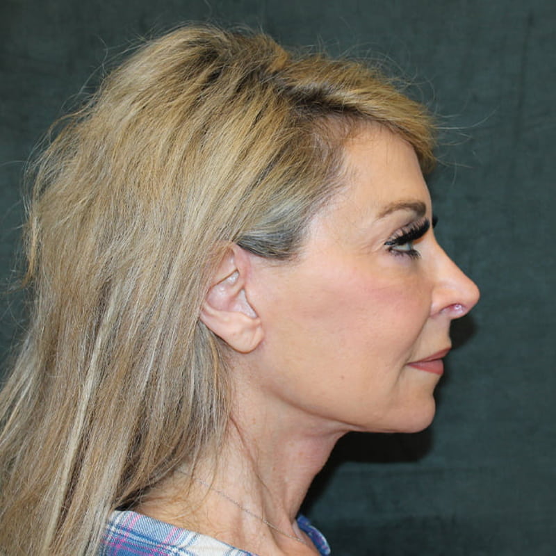 Deep Plane Facelift Before & After Image