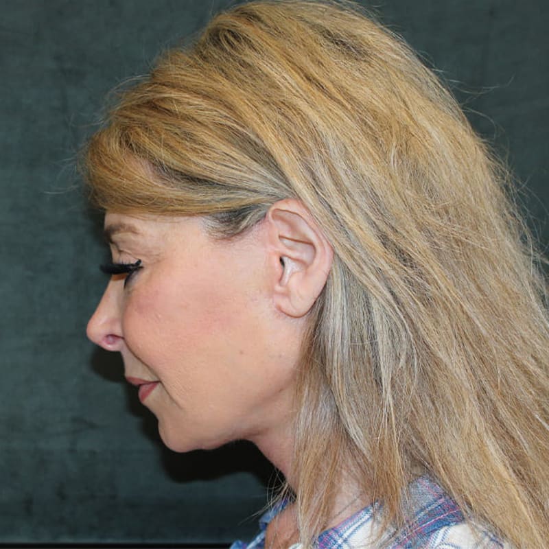 Deep Plane Facelift Before & After Image