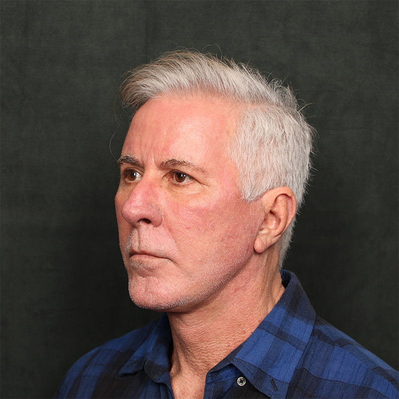 Deep Plane Facelift Before & After Image