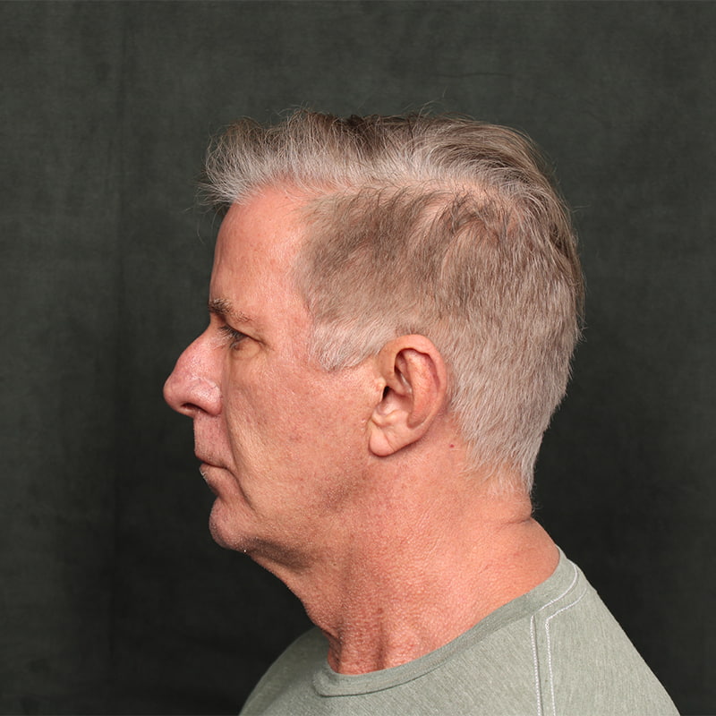 Deep Plane Facelift Before & After Image