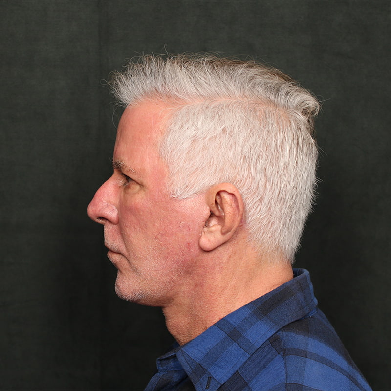 Deep Plane Facelift Before & After Image