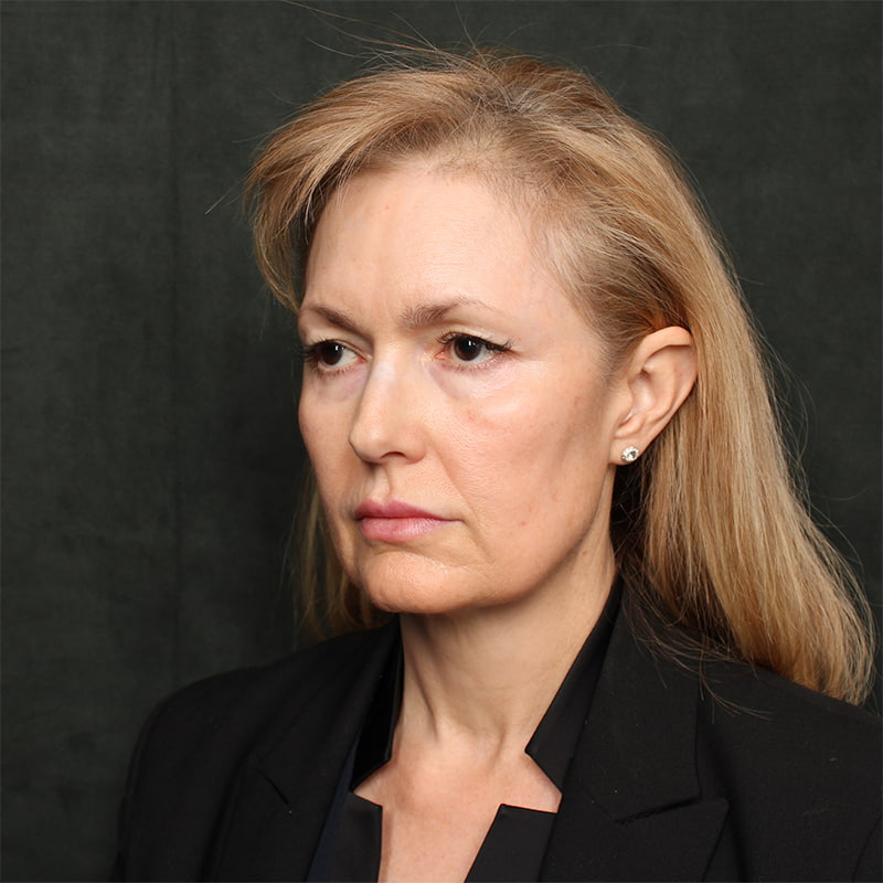 Deep Plane Facelift Before & After Image