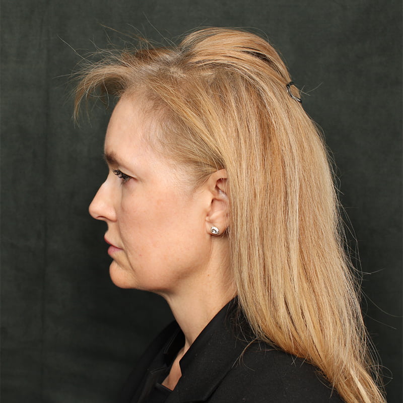 Deep Plane Facelift Before & After Image