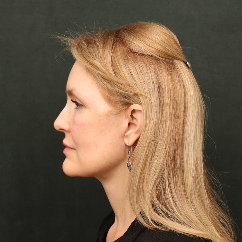 Deep Plane Facelift Before & After Image