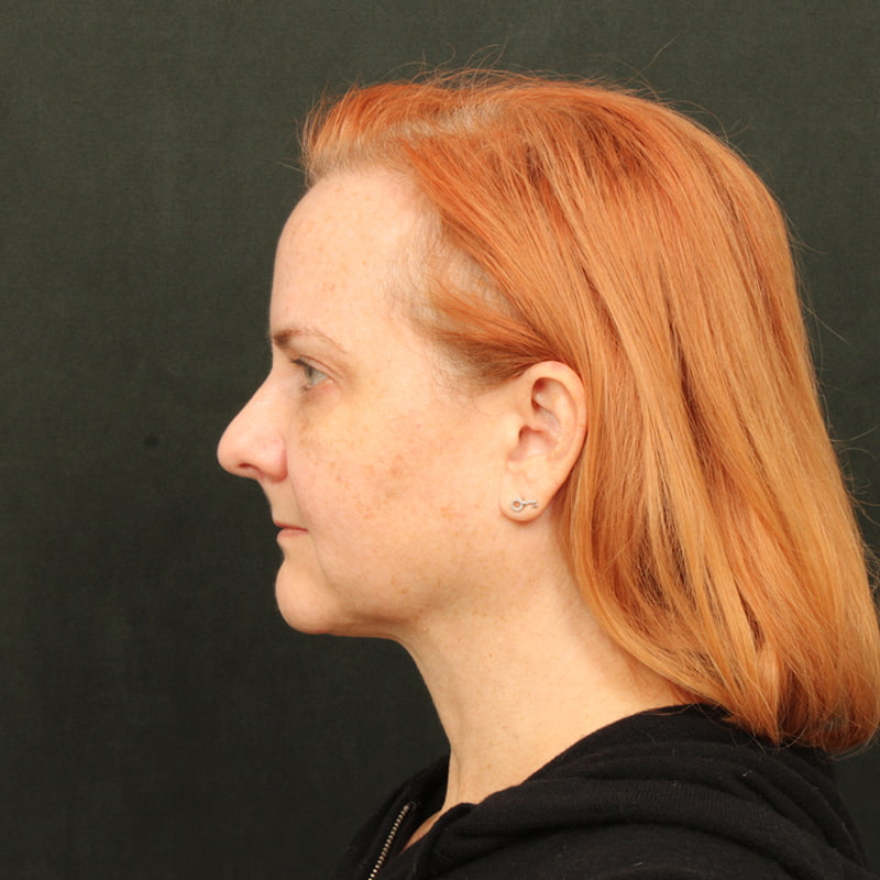 Deep Plane Facelift Before & After Image