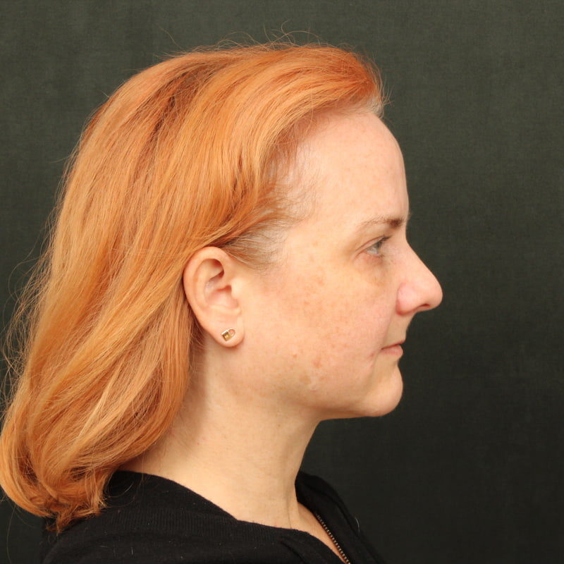 Deep Plane Facelift Before & After Image
