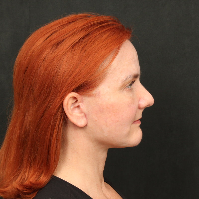 Deep Plane Facelift Before & After Image