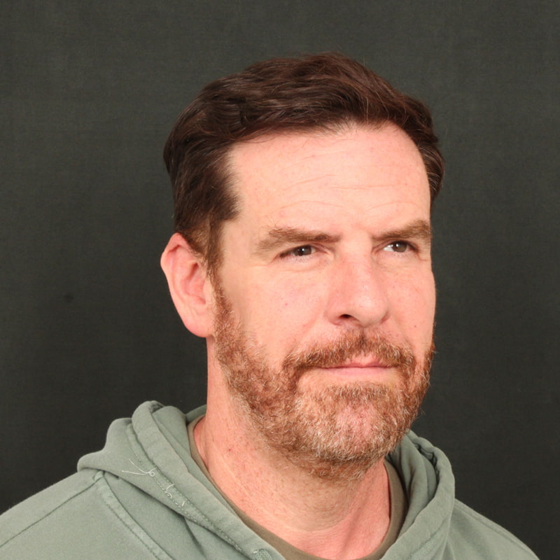 Deep Plane Facelift & Neck Lift Before & After Image