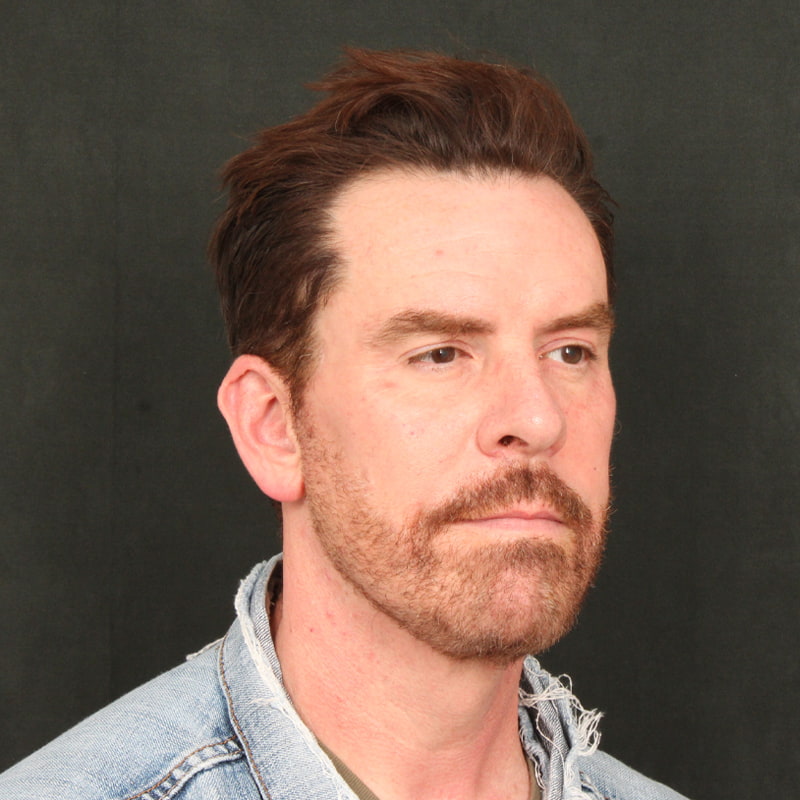 Deep Plane Facelift & Neck Lift Before & After Image