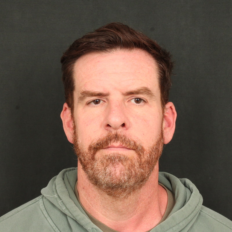 Deep Plane Facelift & Neck Lift Before & After Image