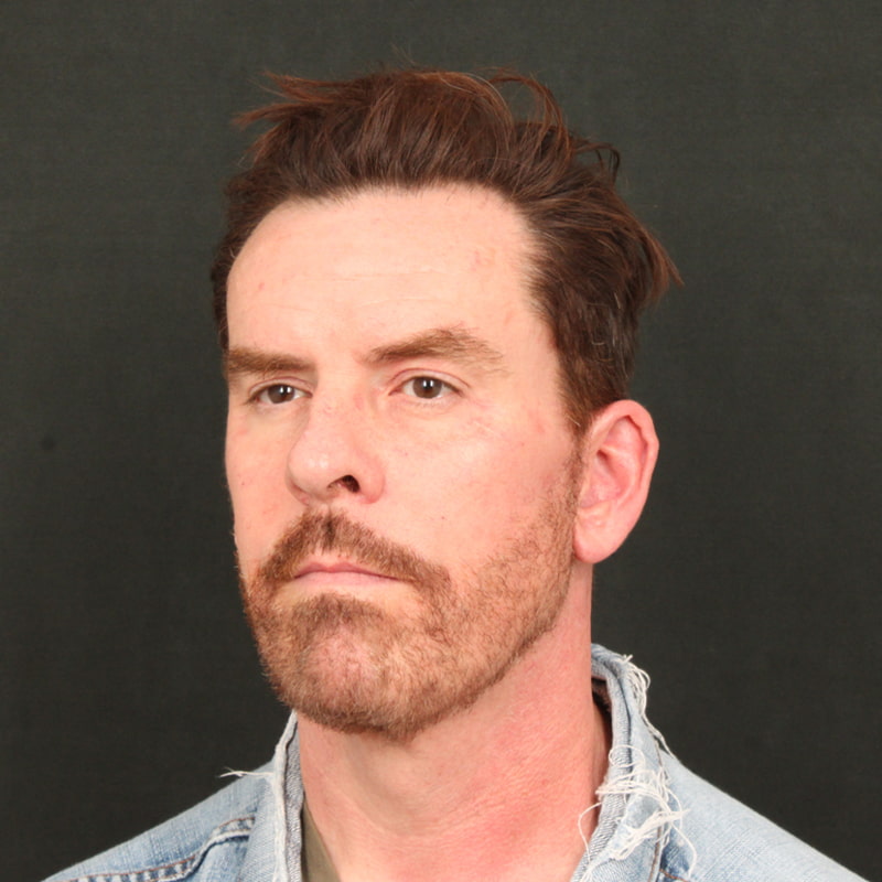 Deep Plane Facelift & Neck Lift Before & After Image