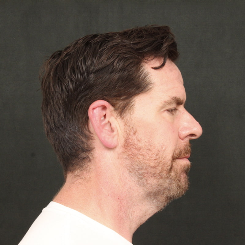 Deep Plane Facelift & Neck Lift Before & After Image