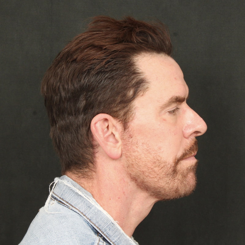 Deep Plane Facelift & Neck Lift Before & After Image