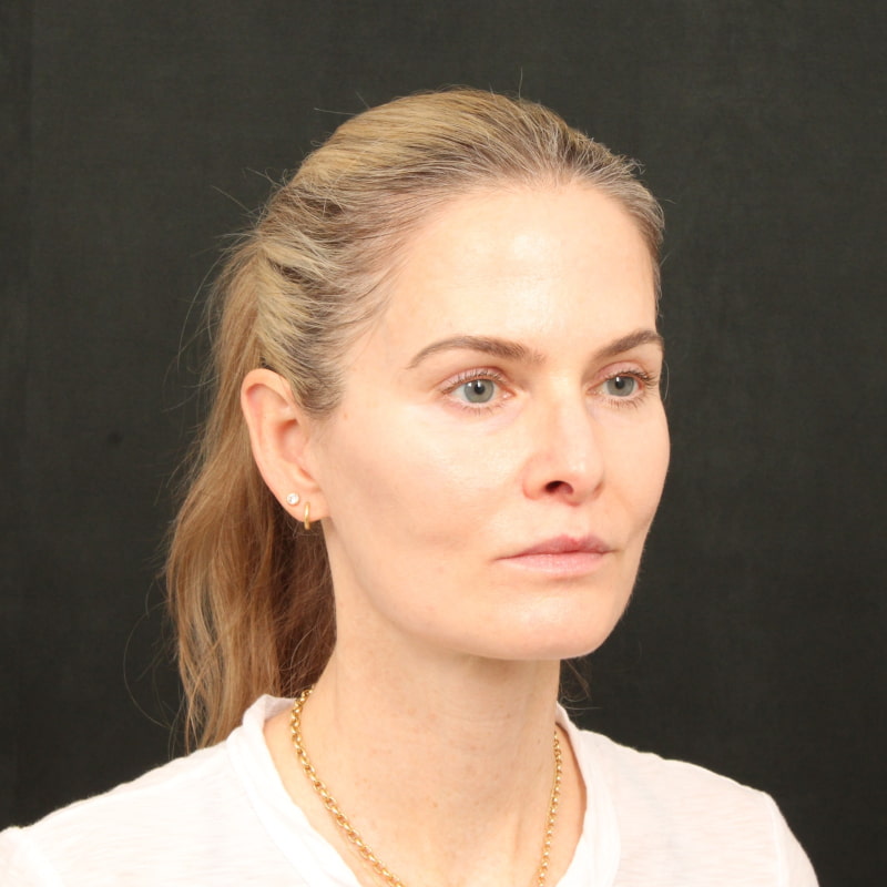 Deep Plane Facelift & Neck Lift Before & After Image