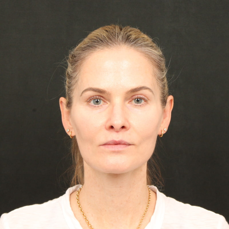 Deep Plane Facelift & Neck Lift Before & After Image