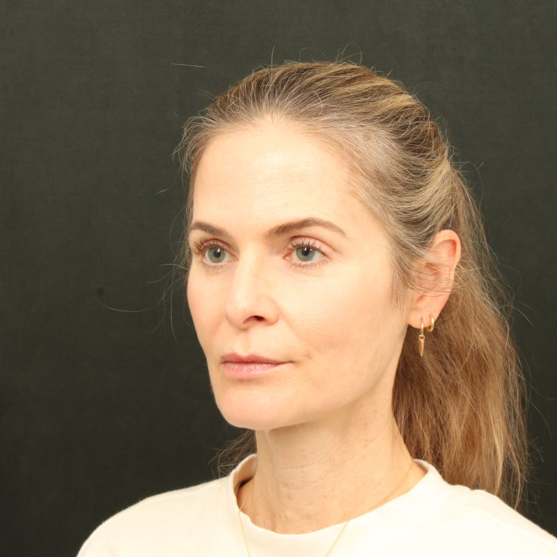 Deep Plane Facelift & Neck Lift Before & After Image