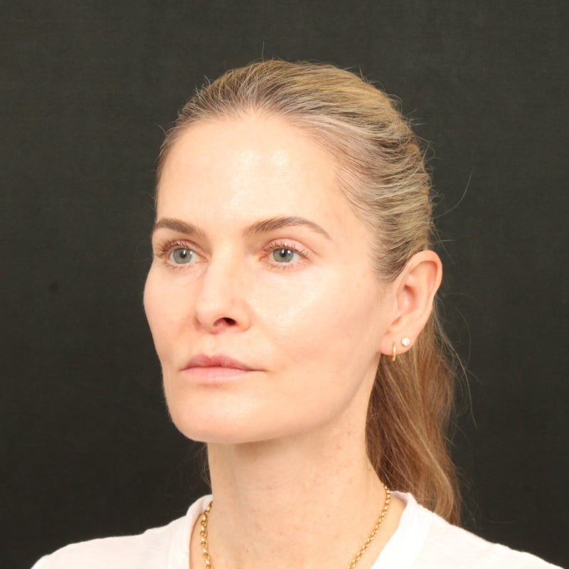 Deep Plane Facelift & Neck Lift Before & After Image