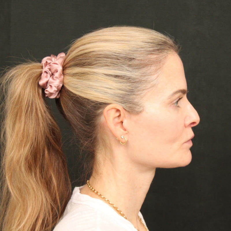 Deep Plane Facelift & Neck Lift Before & After Image