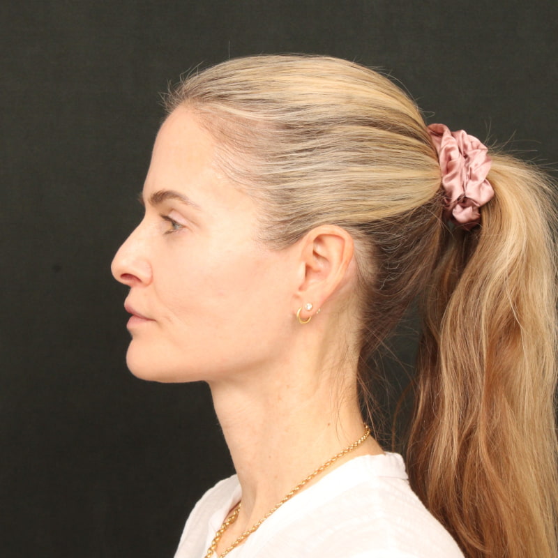 Deep Plane Facelift & Neck Lift Before & After Image