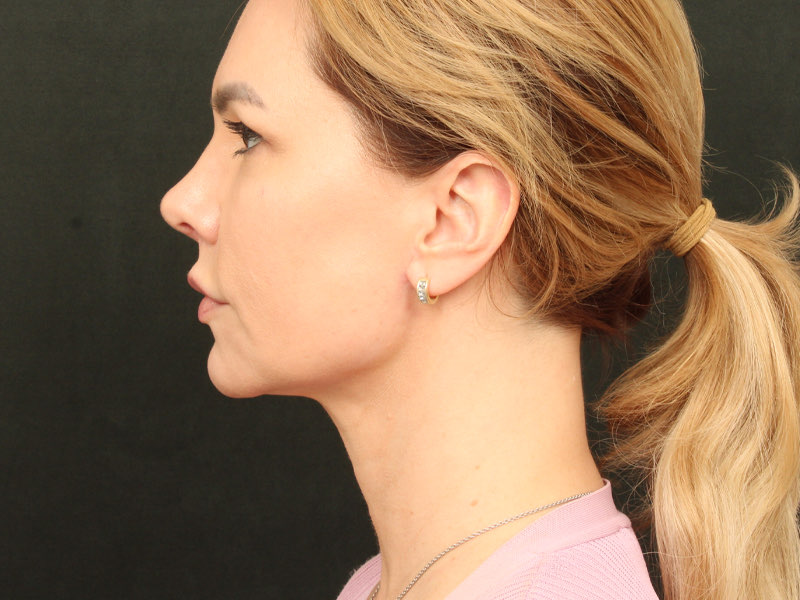 Lip Lift Before & After Image