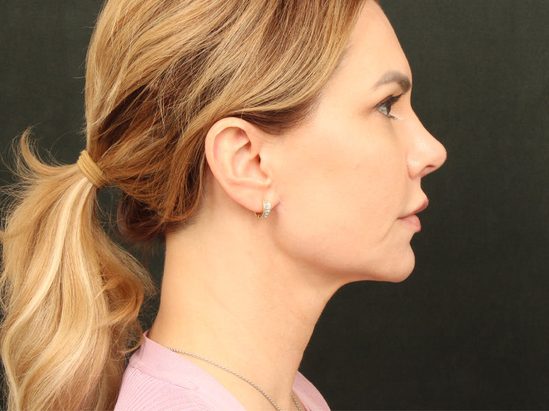 Lip Lift Before & After Image