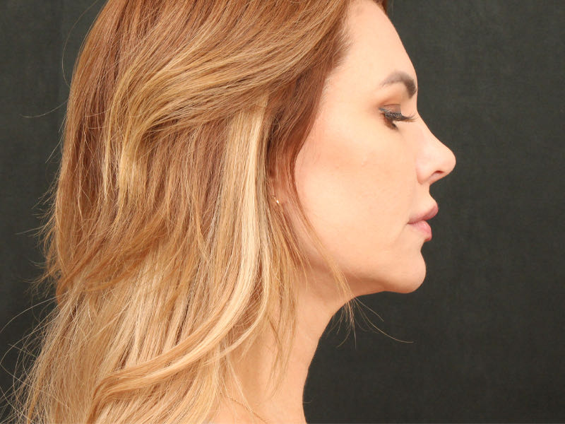 Lip Lift Before & After Image