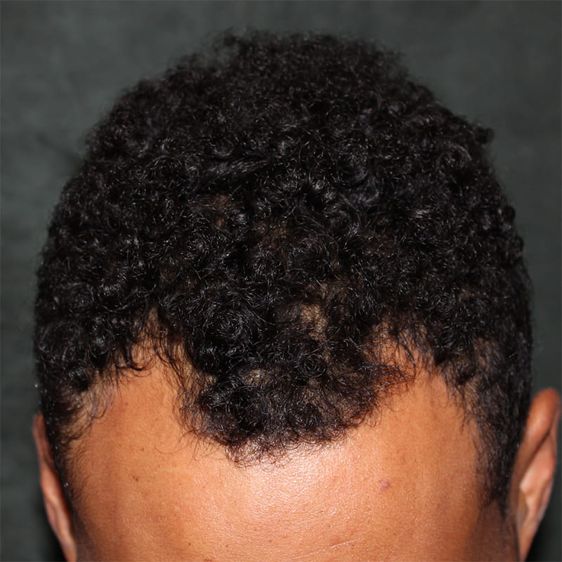 Hair Transplant Before & After Image