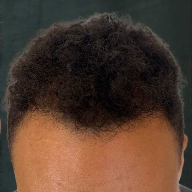 Hair Transplant Before & After Image