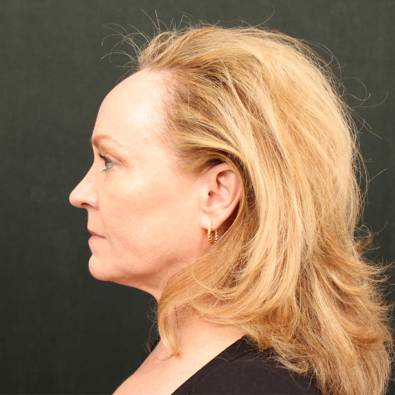 Hair Transplant Before & After Image