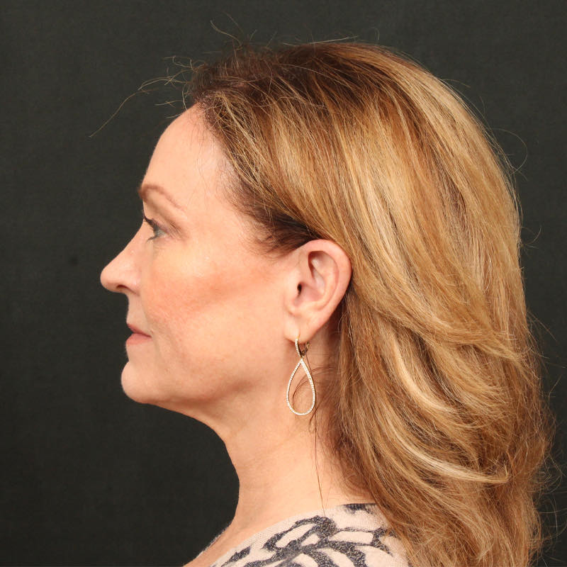 Hair Transplant Before & After Image