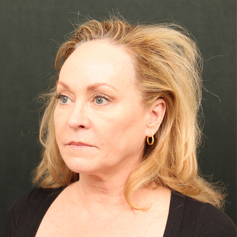 Hair Transplant Before & After Image