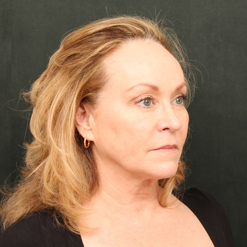 Hair Transplant Before & After Image