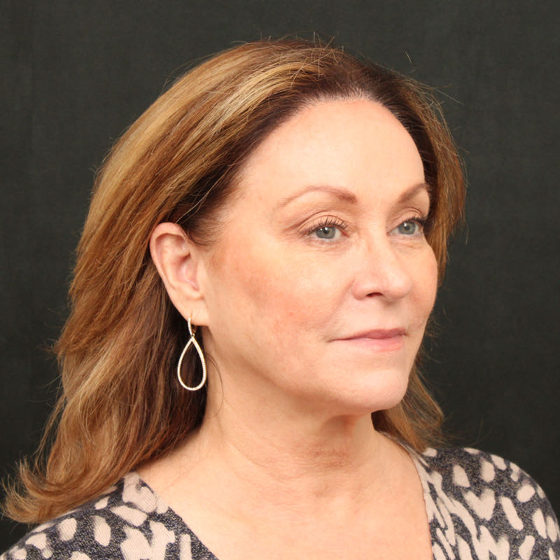 Hair Transplant Before & After Image