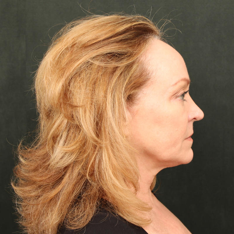 Hair Transplant Before & After Image