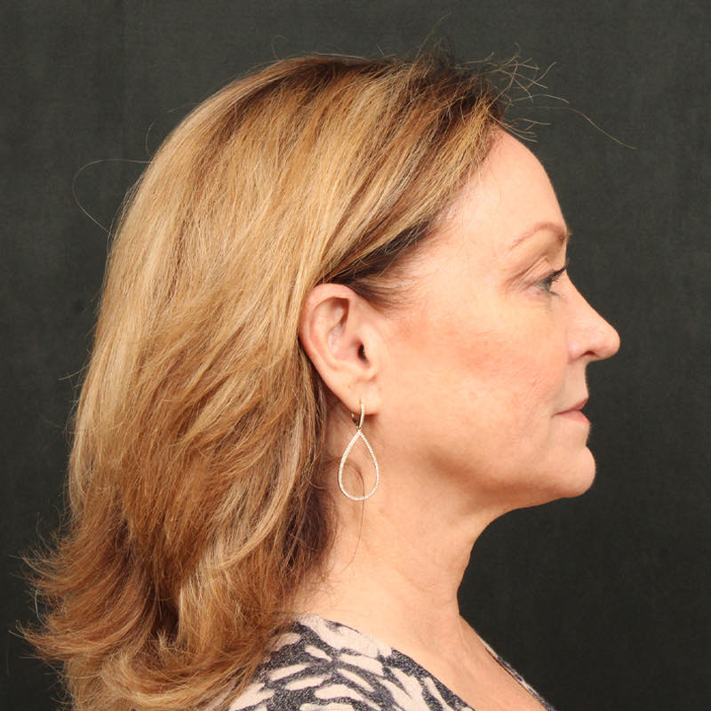 Hair Transplant Before & After Image