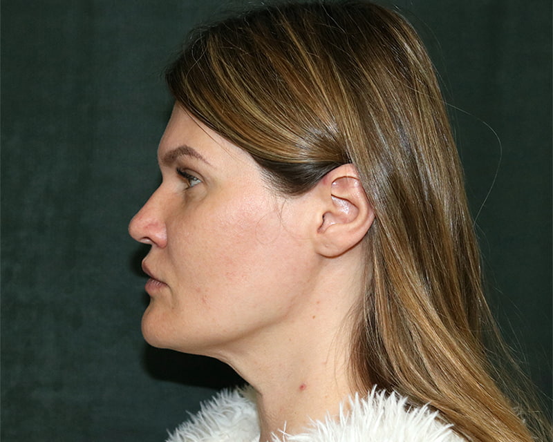 Neck Lift<br><small>(Holiday Neck Lift<sup>TM</sup></small>) Before & After Image