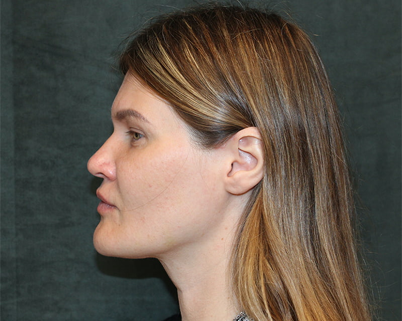 Neck Lift<br><small>(Holiday Neck Lift<sup>TM</sup></small>) Before & After Image