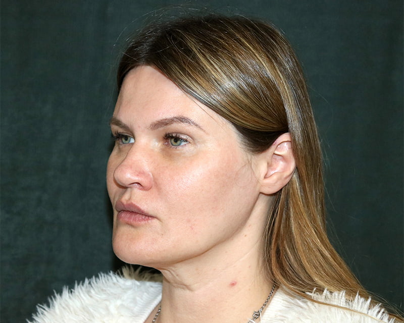 Neck Lift<br><small>(Holiday Neck Lift<sup>TM</sup></small>) Before & After Image
