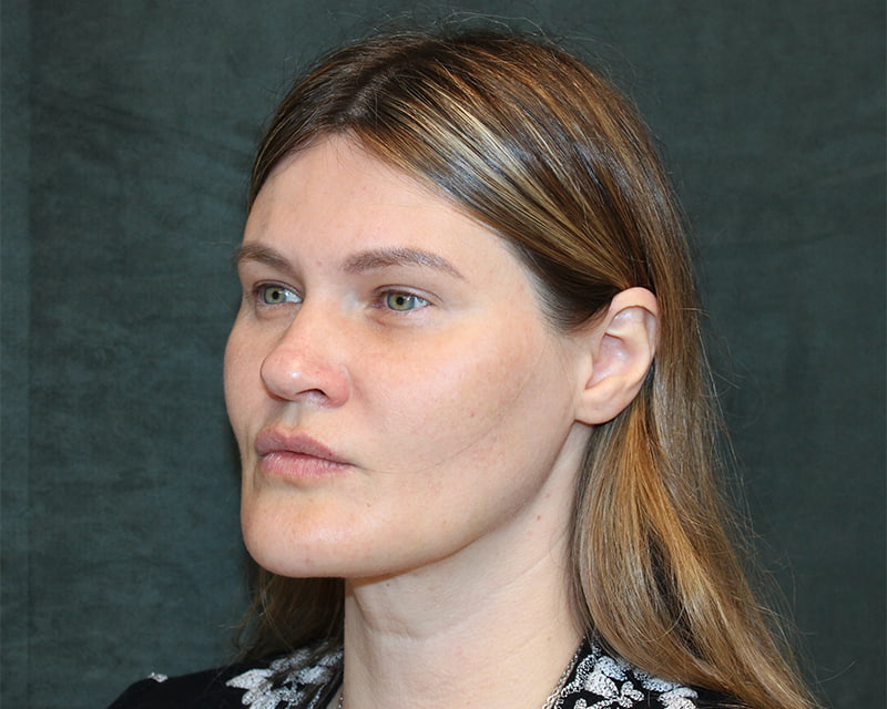 Neck Lift<br><small>(Holiday Neck Lift<sup>TM</sup></small>) Before & After Image