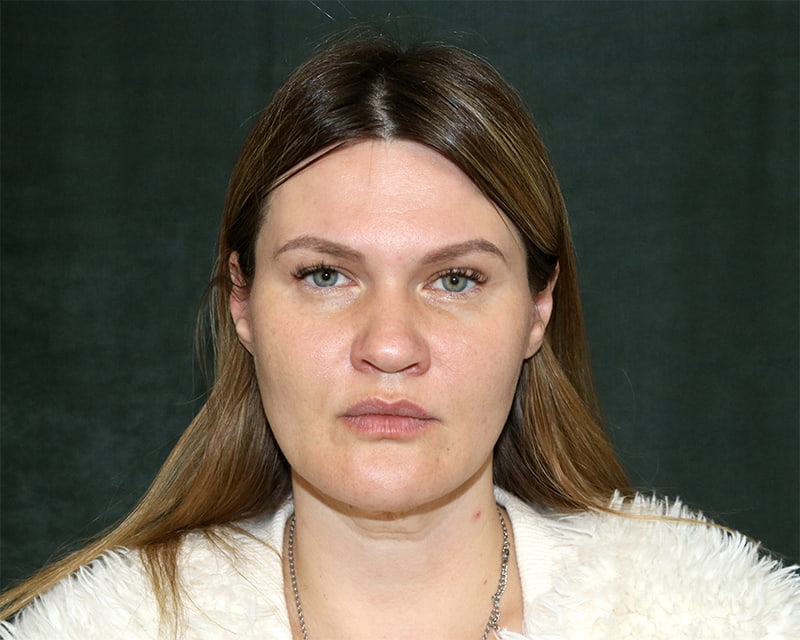 Neck Lift<br><small>(Holiday Neck Lift<sup>TM</sup></small>) Before & After Image