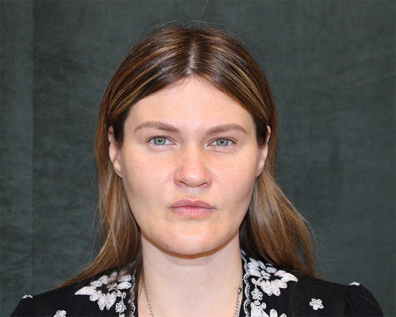 Neck Lift<br><small>(Holiday Neck Lift<sup>TM</sup></small>) Before & After Image