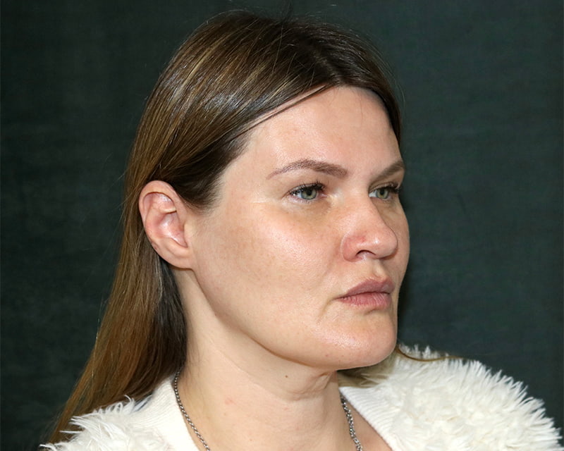 Neck Lift<br><small>(Holiday Neck Lift<sup>TM</sup></small>) Before & After Image