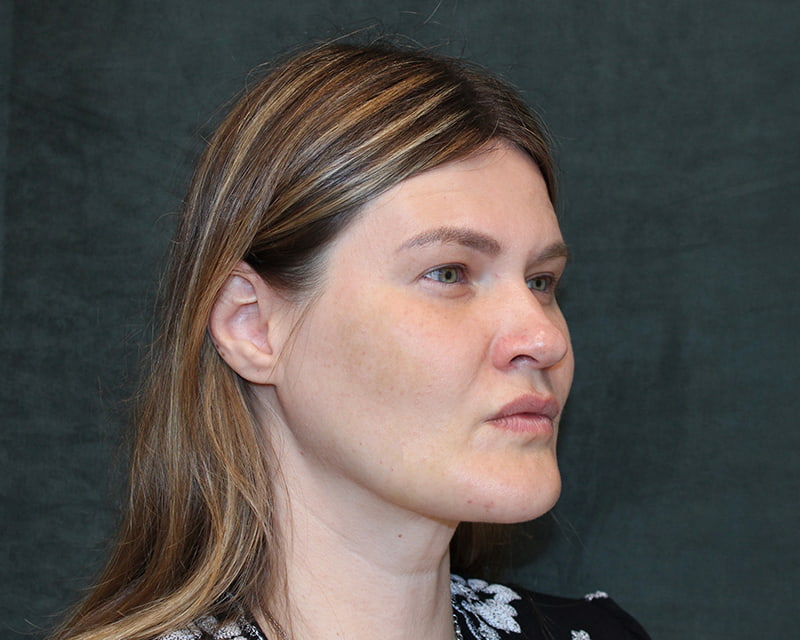 Neck Lift<br><small>(Holiday Neck Lift<sup>TM</sup></small>) Before & After Image
