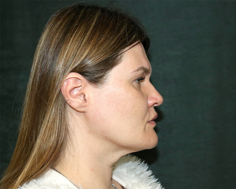 Neck Lift<br><small>(Holiday Neck Lift<sup>TM</sup></small>) Before & After Image