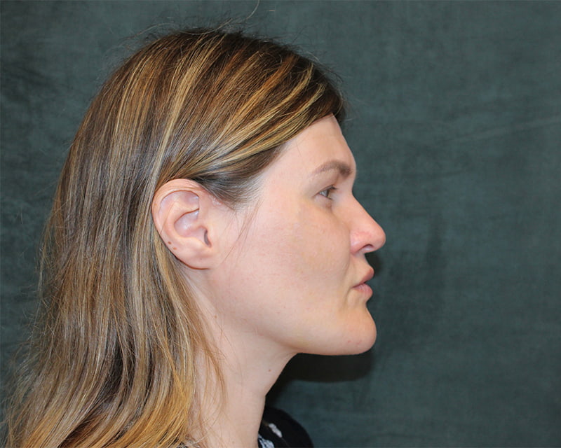 Neck Lift<br><small>(Holiday Neck Lift<sup>TM</sup></small>) Before & After Image