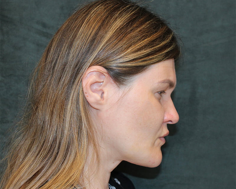 Neck Lift<br><small>(Holiday Neck Lift<sup>TM</sup></small>) Before & After Image