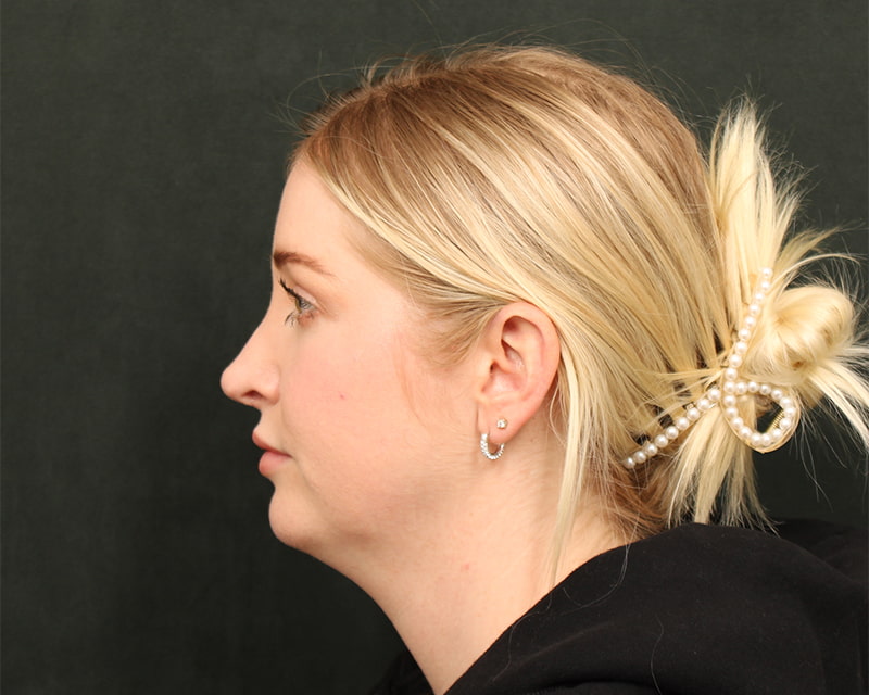Neck Lift<br><small>(Holiday Neck Lift<sup>TM</sup></small>) Before & After Image