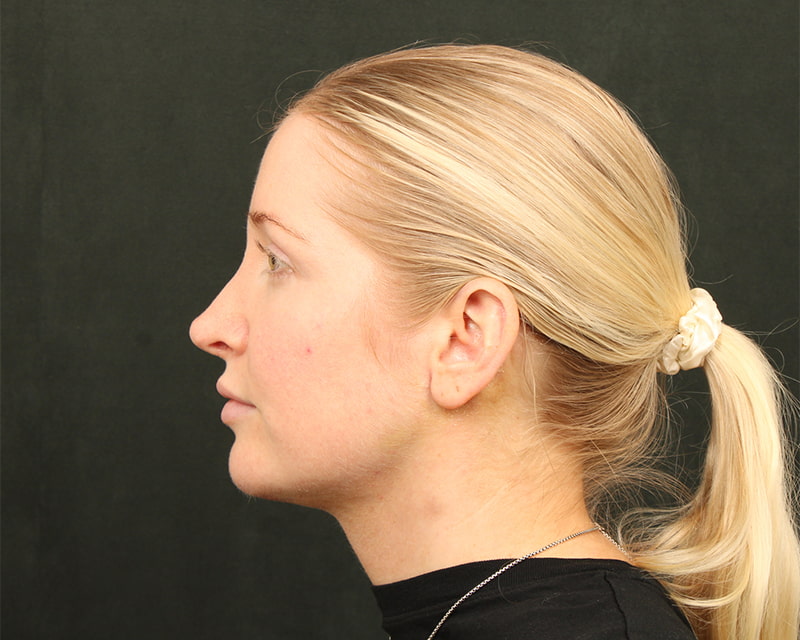 Neck Lift<br><small>(Holiday Neck Lift<sup>TM</sup></small>) Before & After Image