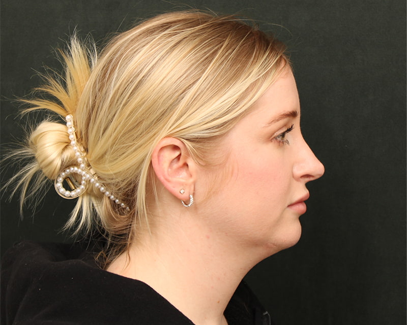 Neck Lift<br><small>(Holiday Neck Lift<sup>TM</sup></small>) Before & After Image
