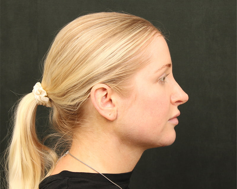 Neck Lift<br><small>(Holiday Neck Lift<sup>TM</sup></small>) Before & After Image